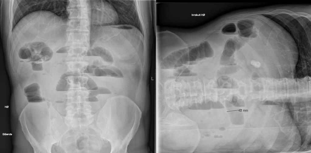 Vedlegg: Røntgen oversikt abdomen CT Bilder Vil