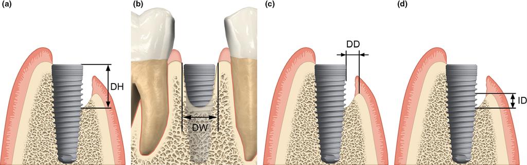 Fig. 1. Clinical measurements of the peri-implant bone defect performed at implant placement. (a) (DH), (b) defect width (DW), (c) defect depth (DD), (d) infrabony defect (ID). Table 1.
