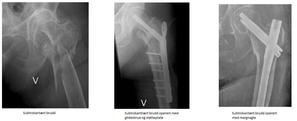 Intertrokantære og subtrokantære brudd Intertrokantære og subtrokantære brudd oppstår lenger nede på lårbeinet enn de