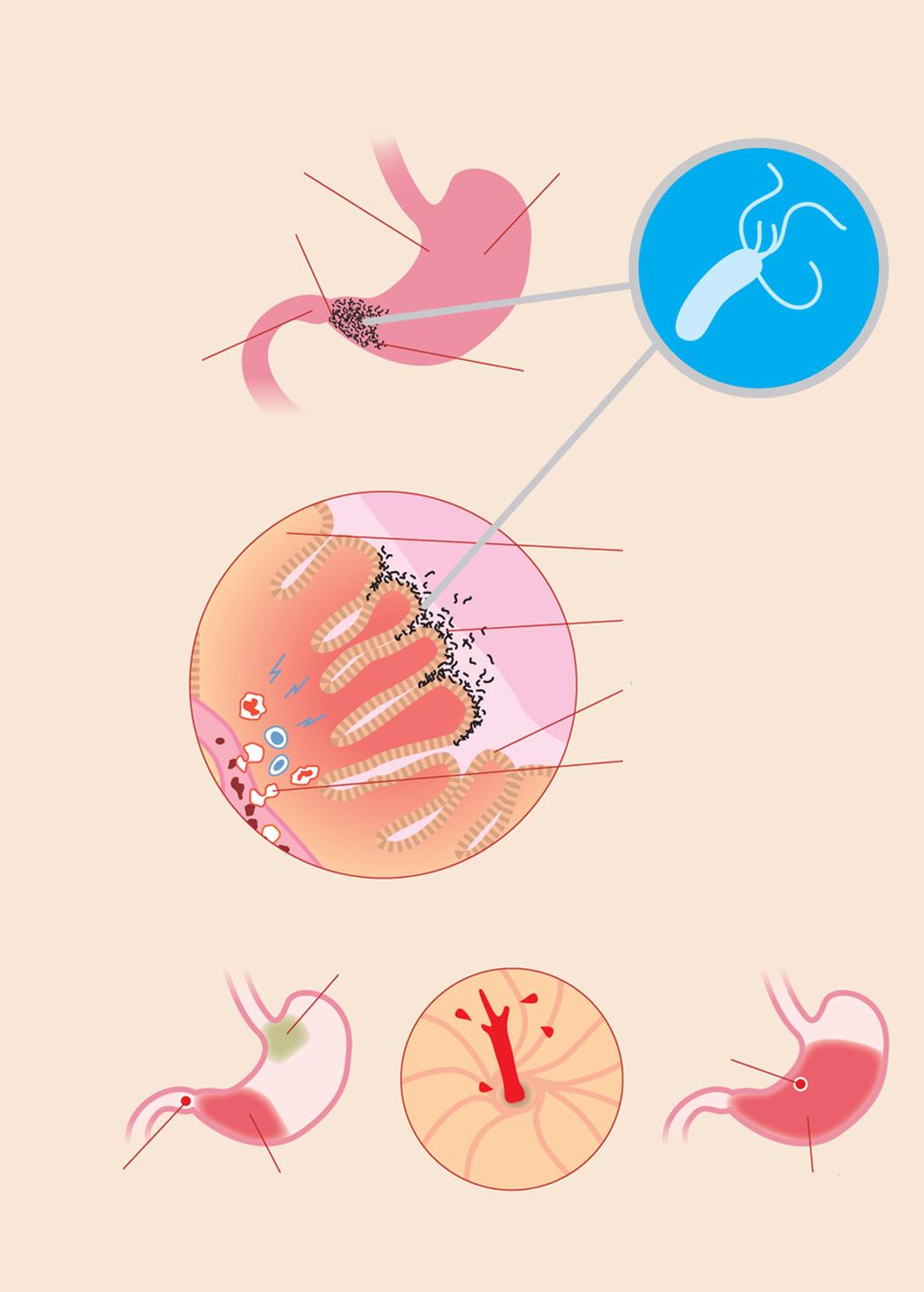 16 دوماهنامهی علمی پژوهشی Infection H. pylori infect the lower part of the stomach, antrum.