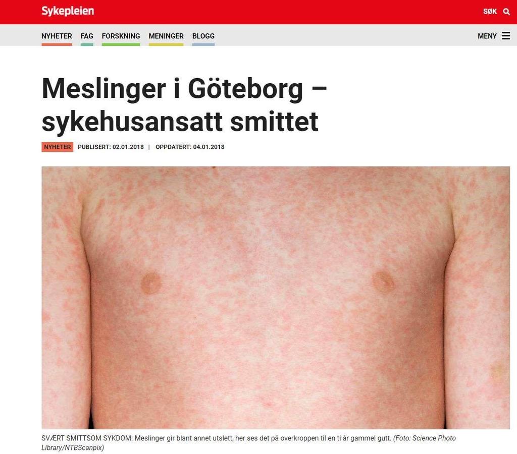 Ved meslingutbrudd er helsetjenesten ofte en arena for smittespredning Alvorlig med smitte til allerede sårbare pasientgrupper En meslingsmittet sykehusansatt har