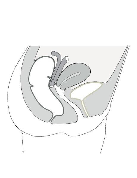 fistel Ureterovaginal fistel (ikke inntegnet) Introduksjon Gynekologisk fistel er en alvorlig tilstand som kan gi store plager for kvinnen.