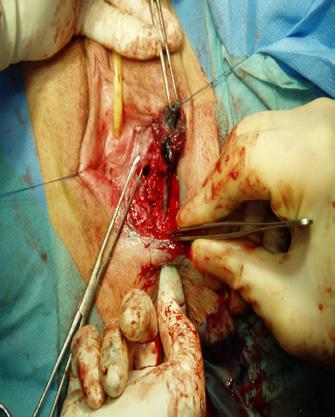 fistelplastikk men permanent deviasjon (enterostomi) blir nødvendig for et flertall av pasientene med strålebetinget fistel.