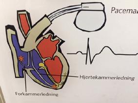 kvikksølv/sink-batteri. PM går med fast frekvens uavhengig av pasientens egenrytme, en virkemåte som medfører at PM kan kollidere med hjertets egenrytme og forårsake ventrikkelflimmer (bilde 3). 1968.