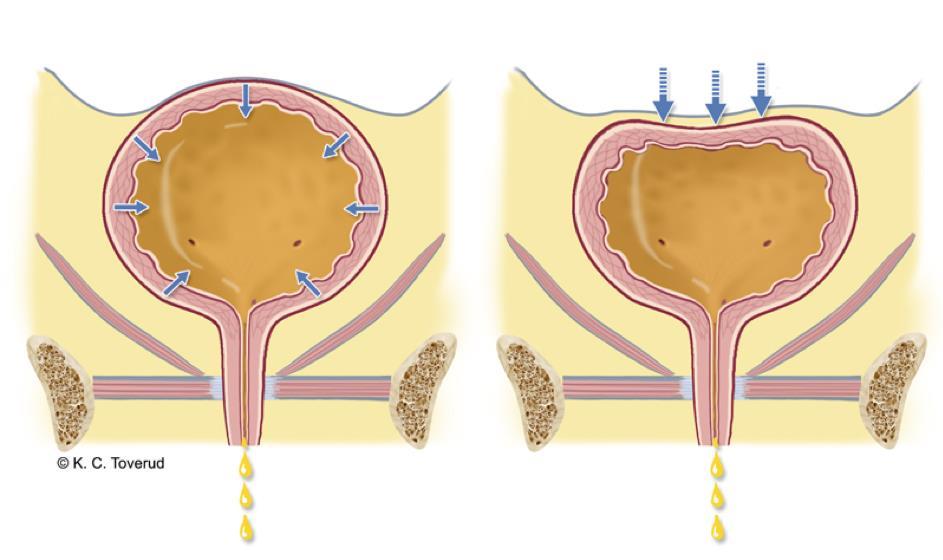 URININKONTINENS STRESSINKONTINENS