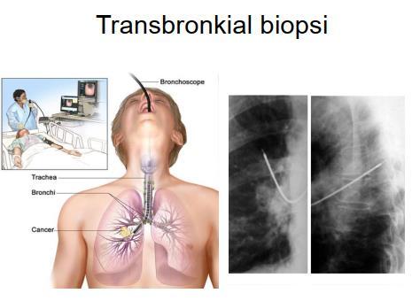 Diagnostisering Vanskelig å diagnostisere pga.