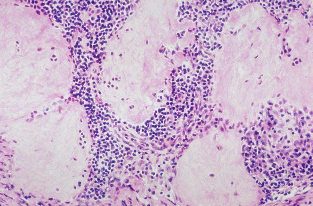 Granulomatøs betennelsessykdom «Knutelignende ansamling