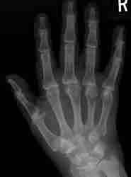Pyrophosphate deposition disease Looks like osteoarthritis May not see calcium deposition