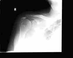 Hydroxyapatite Deposition Originally reported in tendons and soft tissues Can be seen as