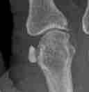 periarticular deposition May