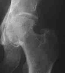= Cartilage Loss Is it focal or