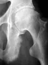 osteoarthritis Symmetrical favours a