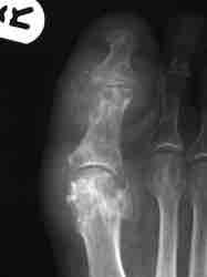 Just as useful as a sign In some arthropathies joint space is lost late Gout In PsA fibrous