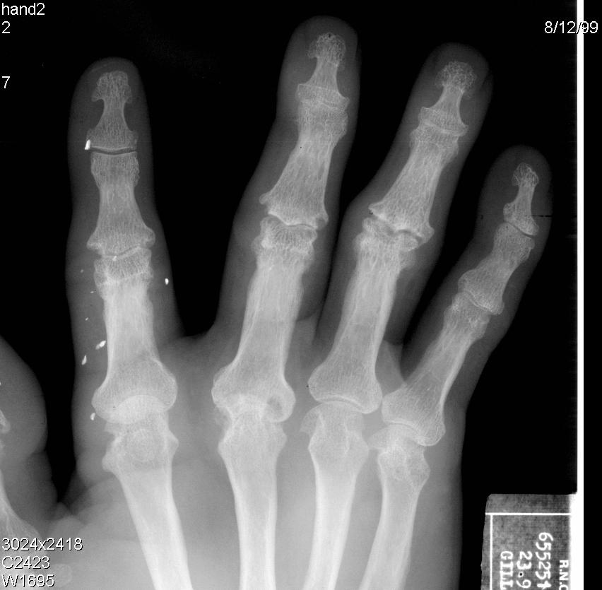 Joint Space Entheseal erosion At enthesis site Associated with new bone enthesophyte