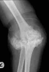 Osteochondral