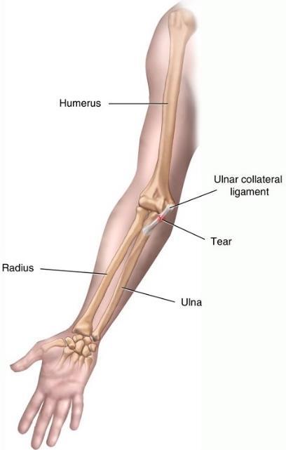 Bildet viser en skade på leddbåndet på innsiden av albuen (det ulnære kollaterale ligamentet).