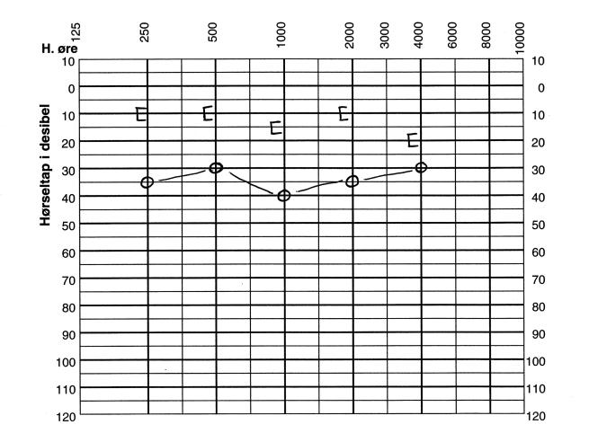 Denne grafen kalles et audiogram. Et rentoneaudiogram er vanligvis målt i frekvensområdet fra lavfrekvent basslyd, 125 Hz, til høyfrekvent diskantlyd opp til 8000 Hz.