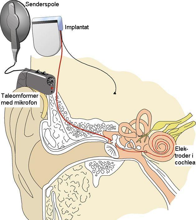 Cocleaimplantat (CI) I 1992 fikk det første døvfødte førskolebarnet i Norge et cochleaimplantat.