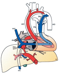 KAPITTEL 20 SHUNTER I FOSTERSIRKULASJONEN Tor-Arne Hanssen og Torvid Kiserud Innledning Den føtale sirkulasjonen skiller seg i stor grad fra sirkulasjonen hos voksne både i form av trykkforhold og