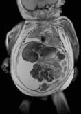 Fig. 12-3a (t.v.) Postmortem MR av et 36 uker gammelt foster som døde intrauterint, og hvor foreldrene ikke ønsket obduksjon. T2-vektet koronalt opptak viste ascites og pleuravæske. Fig.