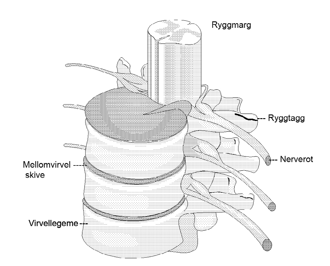 hva er en ryggmargsskade? En skade på ryggmargen har omfattende konsekvenser for de som rammes og for deres pårørende. Man skiller mellom traumatiske og atraumatiske årsaker til ryggmargsskader.