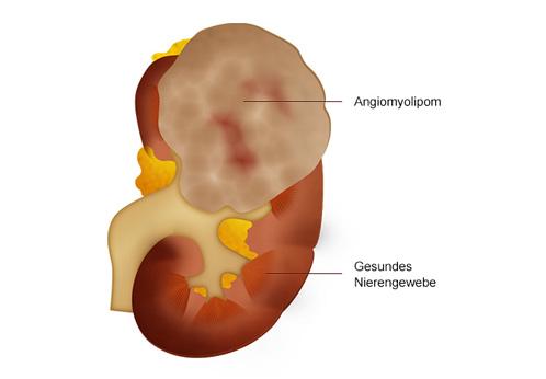 Embolisering av angiomyolipom i venstre nyre Mest vanlige benigne tumor i nyre. Består av blodårer, glatte muskelceller og fett.