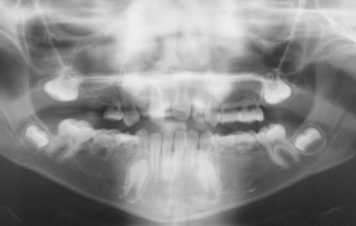 Figur 11. OPG av en ung pasient med Williams syndrom og oligodonti. Figur 12. Pasient med Williams syndrom og små og skrujernforede fortenner.