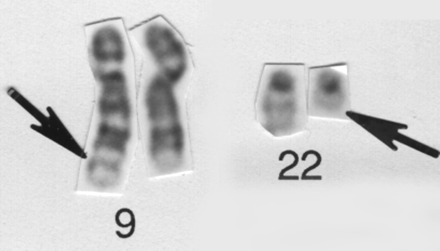 (Philadelphiakromosomet). En bit av dette kromosomet er byttet med en bit påp kromosom 9.