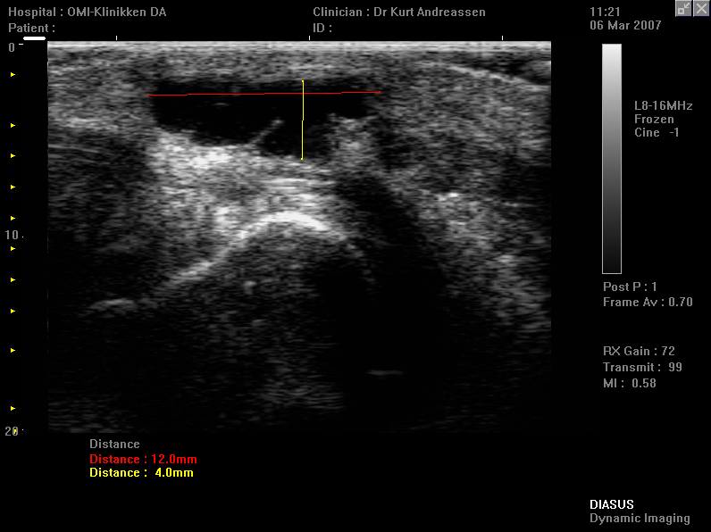 Bilde 2 Hofte Artritt/kapsulitt i hofteleddet er vanligvis lett å se på ultralyd hvis man har en rimelig sikker klinisk diagnose først (2,4).