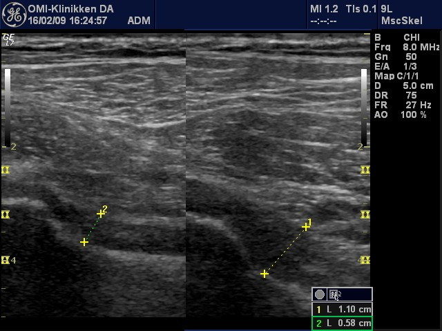 Bilde 3 Psoasbursitt og trochanterbursitt (2,4)ses godt på ultralyd. Tendinopatiene i gluteus medius/minimus er ikke så langt lette å se på ultralyd.