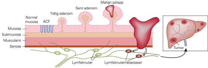 Utvikling fra normal mucosa til