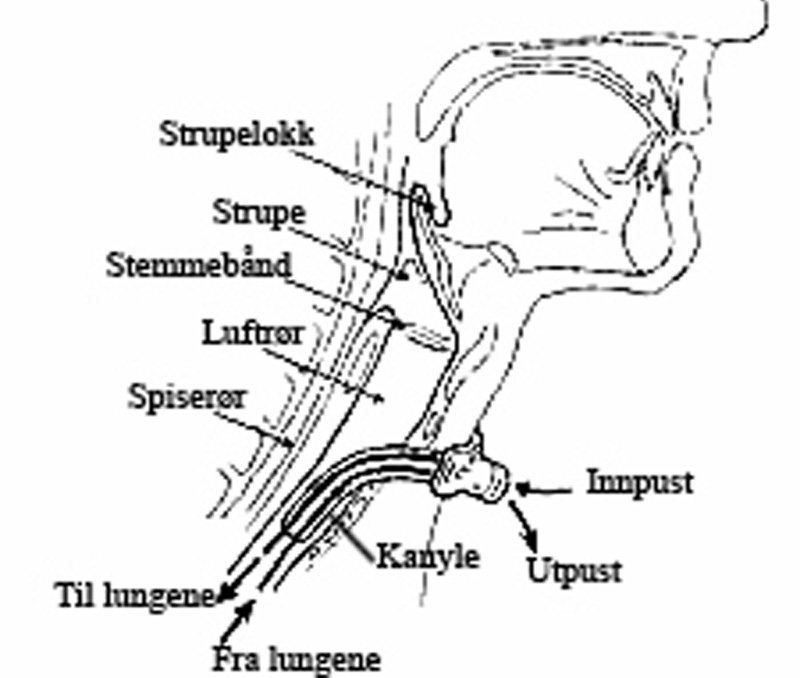 INFORMASJON FRÅ ØYRE-NASE-HALSAVDELINGA INNHALD SIDE Tracheostomi 1 Kanylen 2 Endringar i luftvegar / slimhinne 3 Stell / hygiene / råd 4 Bruk av luftfuktar 4 Drypping av kanylen 4 Suging av kanylen