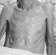 Cachexia...the shoulders, clavicles, chest and thighs melt away. This illness is fatal.