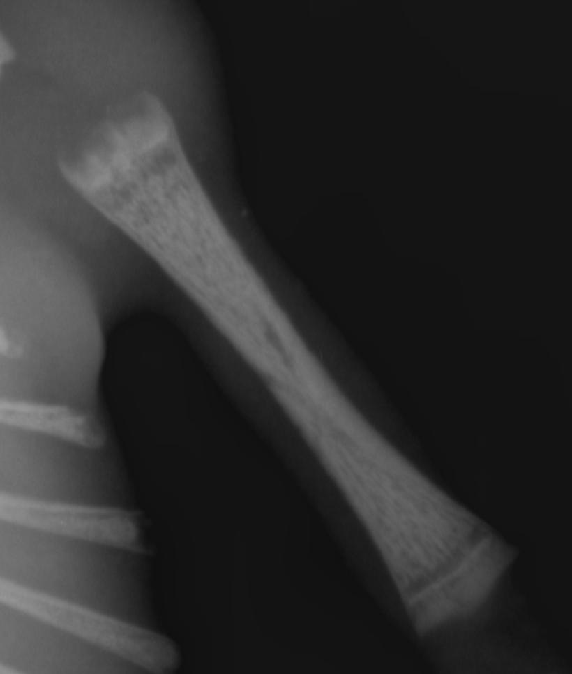 Femur normal