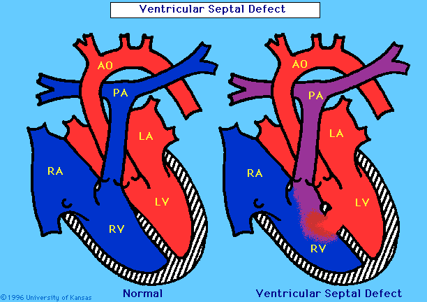 Stort spekter: Ventrikkel Septum