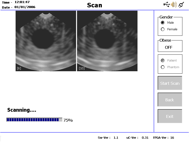 Scan Trykk på Start Scan på skjermbildet Pre-Scan eller trykk inn knappen på ultralydproben for å initiere en skanning. Skanskjermbildet vises så snart skanningen startes.