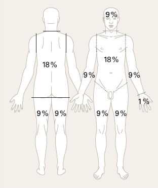 Areal av kroppsoverflate i prosent, Voksen Voksen Barn Trunkus forflate: 18 % Trunkus bakflate: 18 % Hver overekstremitet: 9 % Perineum: 1 % En håndflate: 1 % Hode + Hals: 9 % 18% Hver