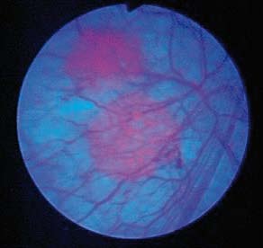 Krefregisteret var det 1263 ny tilfelle av cancer i ureter, blære og urethra i 2005, og majoriteten (anslagsvis 1150) var lokalisert til blære.