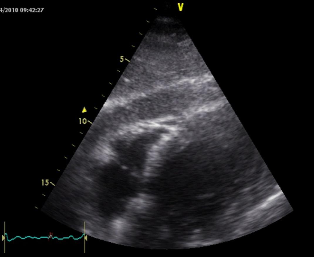 Aetiology N % 1 Rec % 2 Disch % 2 & treat Cardiac (not tamponade) 66 44,3 20 30,3 19 28,8 4H+4T Hypoxia 20 13,4 17 85,0 3