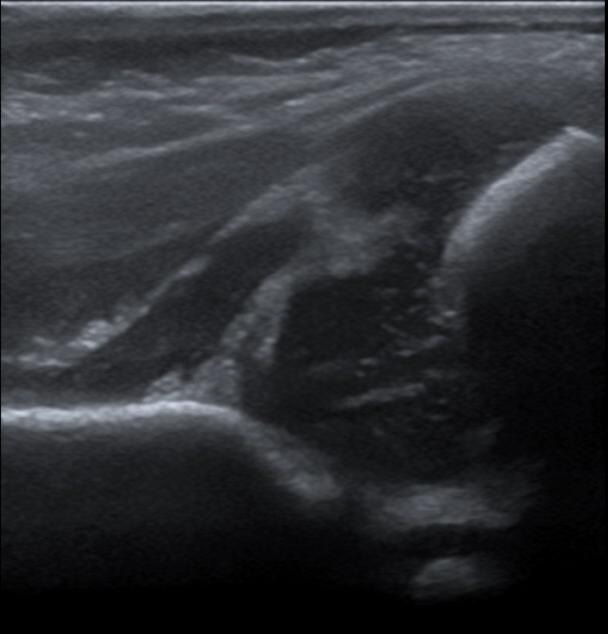 Figur 9 Bildet viser umodent hofteledd med alfavinkel på cirka 53 og dårlig dekning av caput femoris.