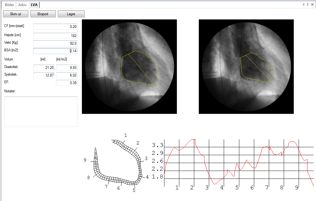 Et eksempel på resultatet er følgende. I vinduet er ventrikkel volumene og ejeksjonsfraksjon beregnet med Area-Length metoden og de regionale sammentrekninger med Senterlinje metoden vist.