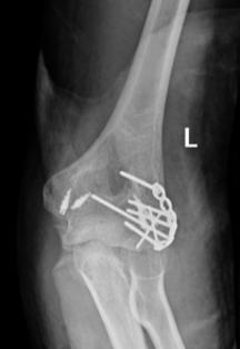 Klassifikasjon Dubberley et al, JBJS 2006 Billeddiagnostikk Double arc sign Konvensjonell rtg 66% sensitivity CT med 3D