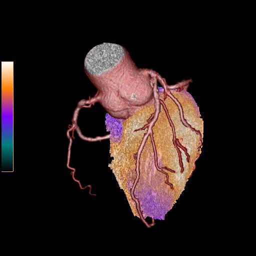 CT-SPECT