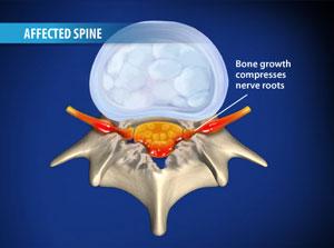 Spinalkanalen og foramen intervertebrale Konsekvens av