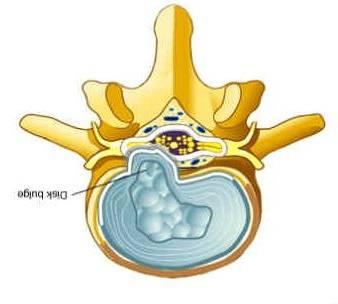 Intervertebralskiven Protrusjon/prolaps sentralt Akutt lumbago Ofte SLR og