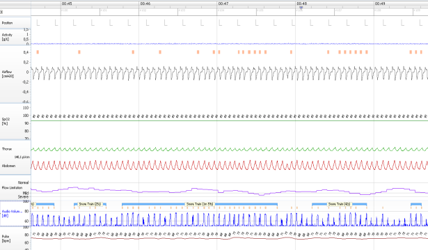 (Polygrafi eks Embletta, Apnegraf) Thorax, abdomen, posisjon, flow, snorking, pulsoksymetri, puls Med EEG = Polysomnografi Polygrafisk