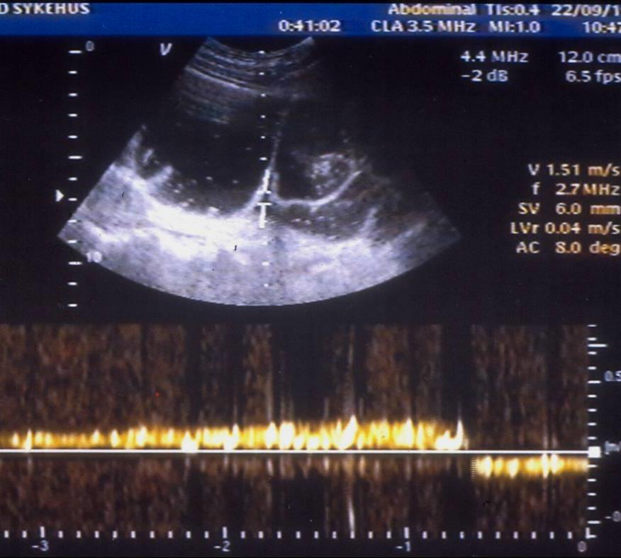 Ileum terminale Folvik et al.