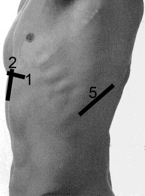 6+ -en systematisk US-undersøkelse av abdomen Stasjon 1 Transversalsnitt i epigastriet. Aorta, vena cava, art. mesenterica superior, truncus coeliacus, pancreas og lever.