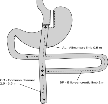 Gastro-intestinal bypass, Roux-Y Magesekk-lomme Tynntarmsløp for mat (alimentært løp) 0,6-1,5 m Fellesløp for fordøyelse 2,5-3,5 m Tynntarmsløp for magesaft, galle og bukspyttsaft (bilio-pankreatisk