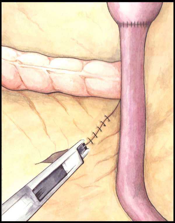 Closure of mesenteric defects by our new technique